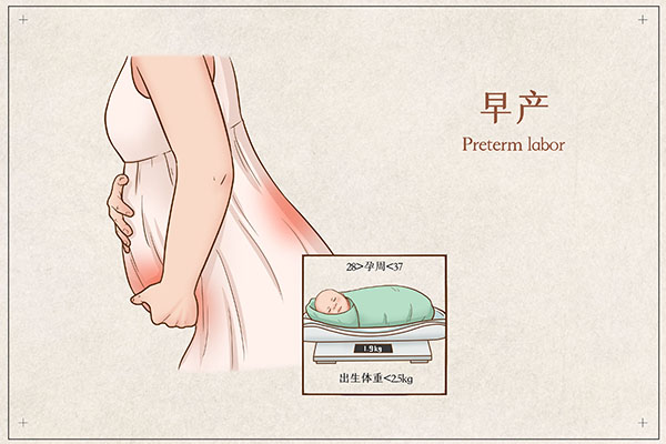 孕妇早产